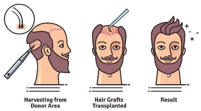 Hair transplant in Gurgaon a Permanent Solution.